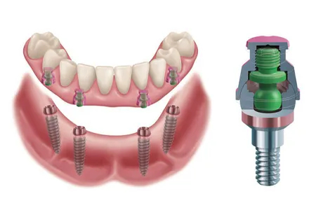 Denture On Implant – Removable Full Arch Solution