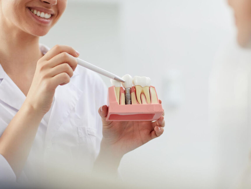 Understanding the Benefits of Dental Implants