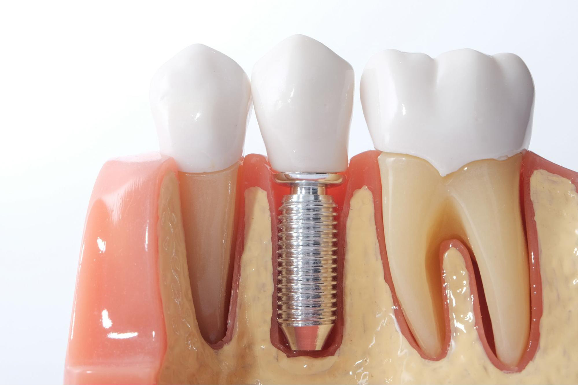 The Lifespan of a Dental Implant