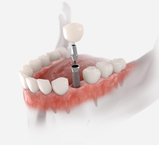 Implants dentaires: Le Guide Ultime pour un Sourire Sain