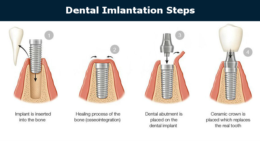 A figure showing the various stages of implant placement in the jawbone.