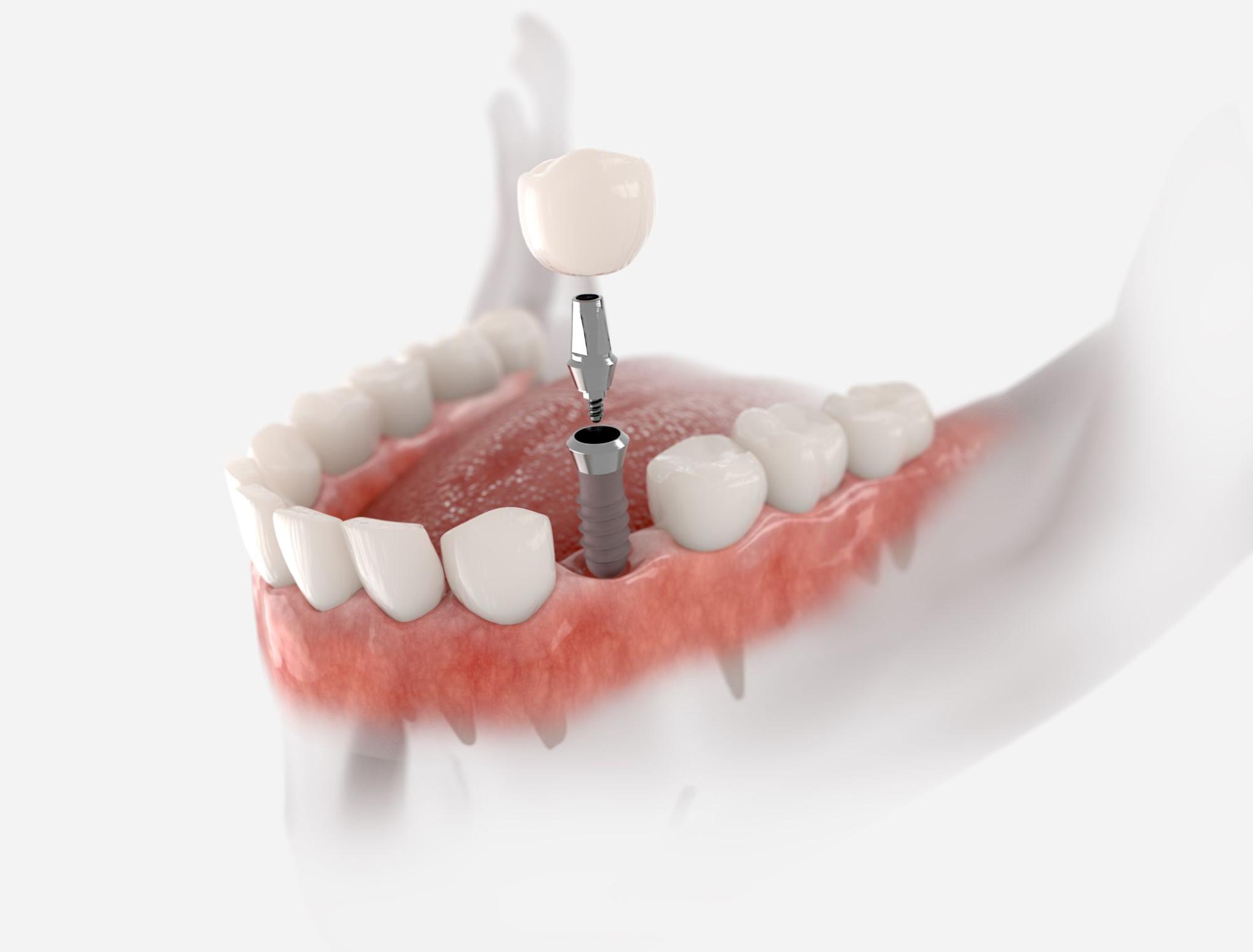 Dental Implants: The Ultimate Guide to a Healthy Smile
