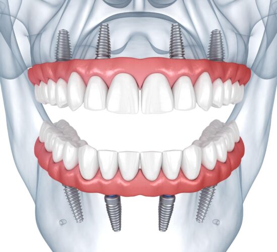 Promotion en cours : Réhabilitation complète de l’arcade avec des implants dentaires All-on-4