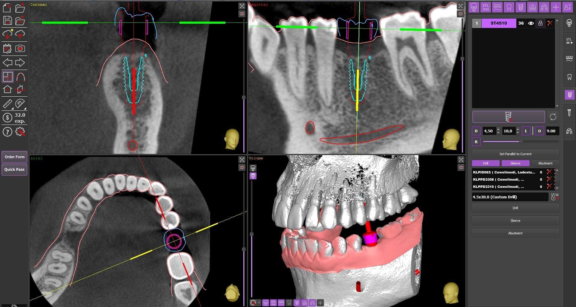 A screenshot from an advanced dental implant planning software