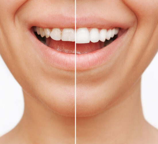 Promotion en cours : Découvrez votre plus beau sourire grâce aux facettes dentaires