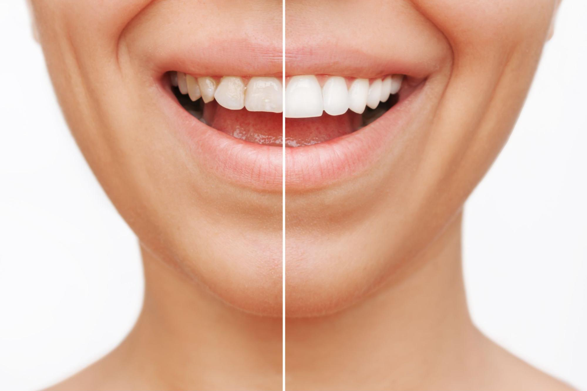 Promotion: Unveiling Your Best Smile with Dental Veneers
