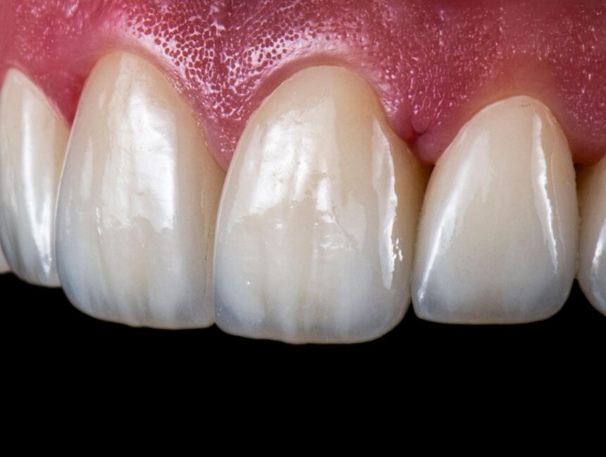 E-Max Veneers and the First Fit technology in Montreal, Canada