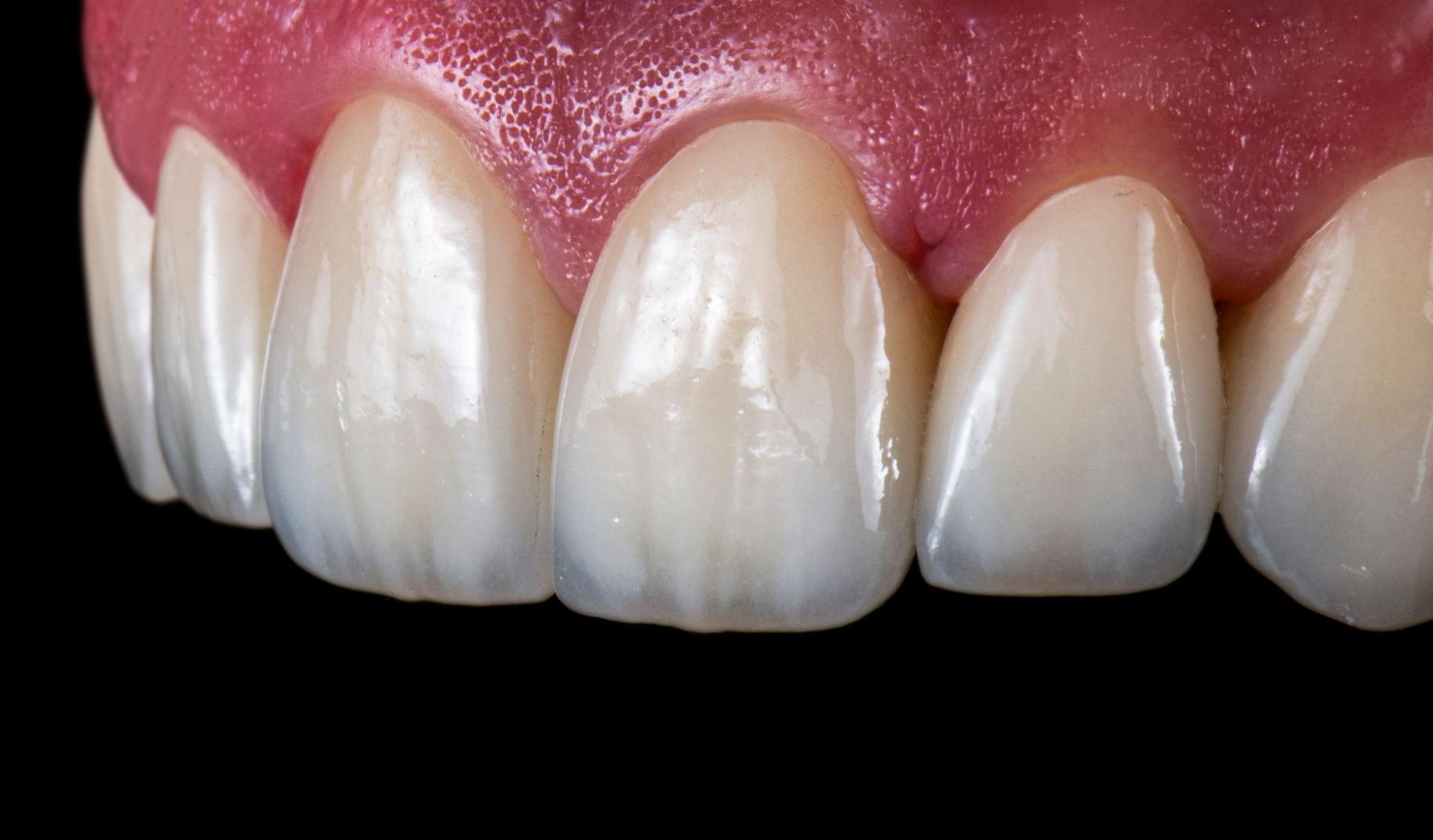 E-Max Veneers and the First Fit technology in Montreal, Canada