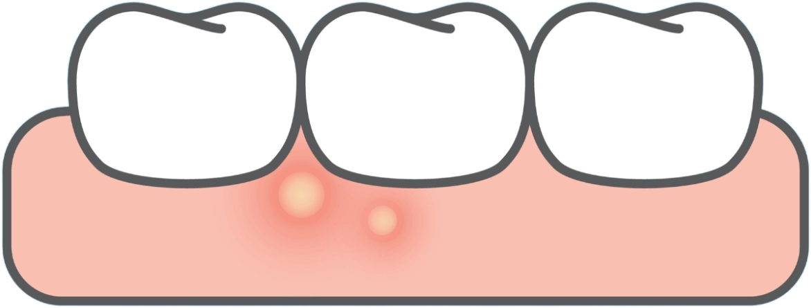 An abscess or boil is a build-up of pus in the teeth or gums and is caused by an infection
