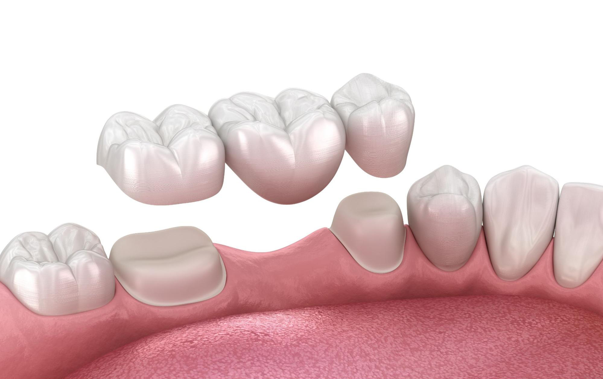 Dental Bridges