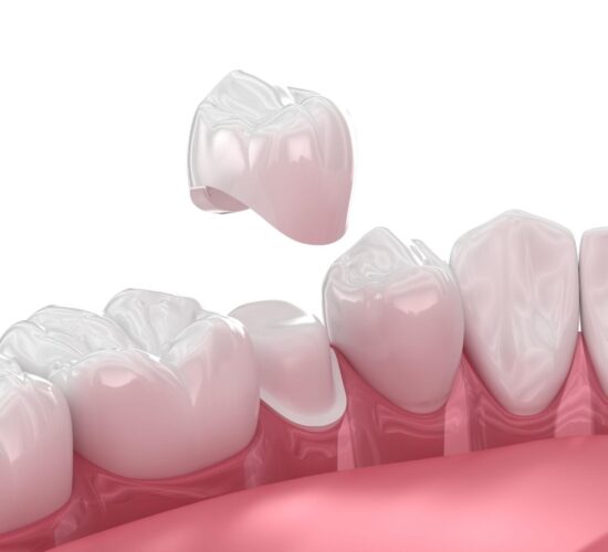 Aperçu des Couronnes Dentaires