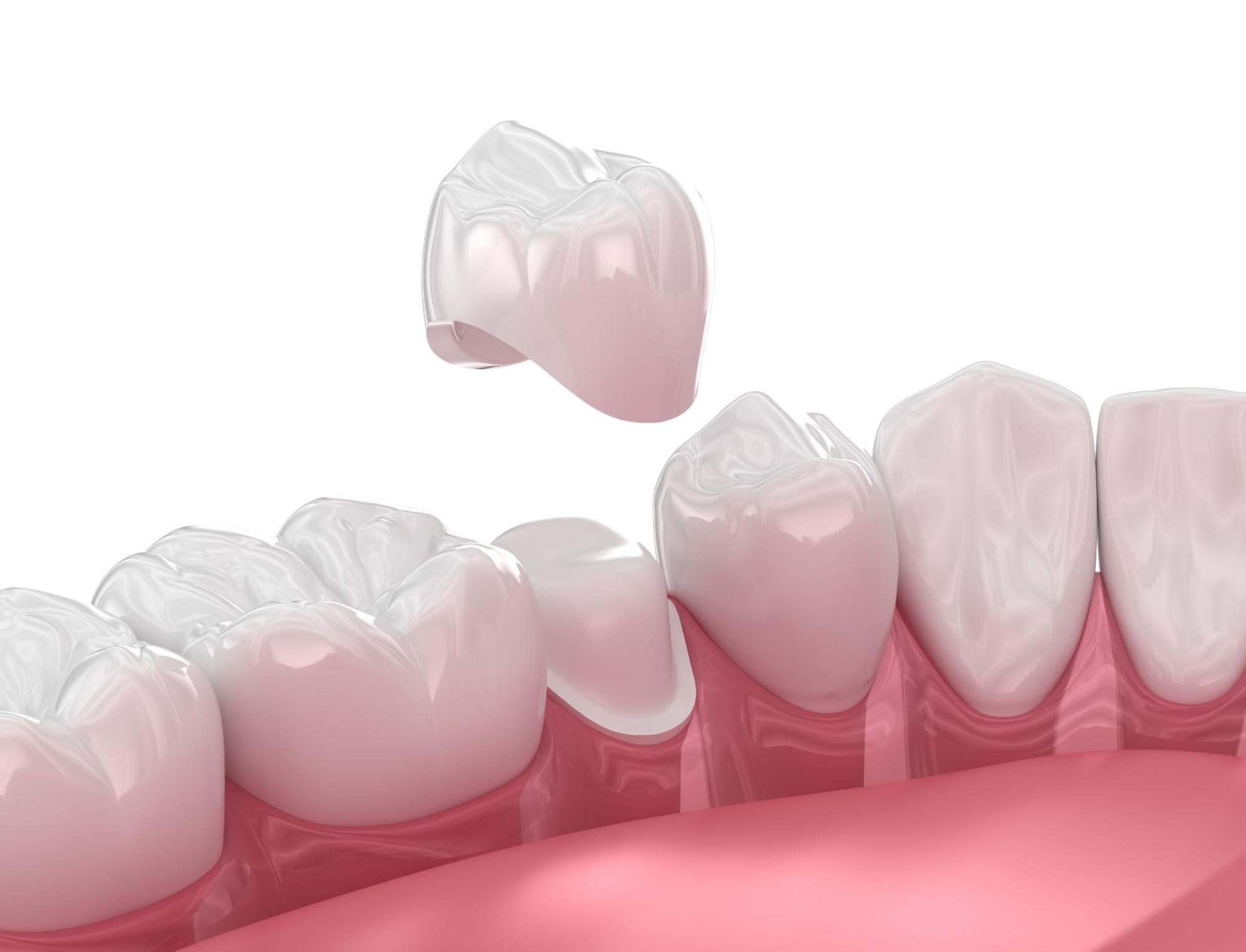 An Overview of Dental Crowns