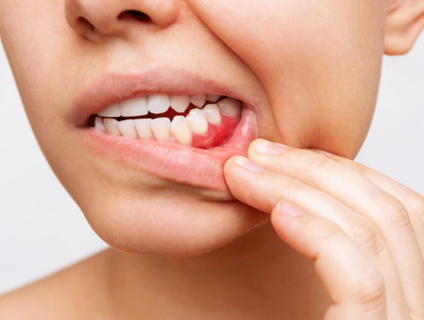 Gingivitis: The Earliest Stage of Gum Disease