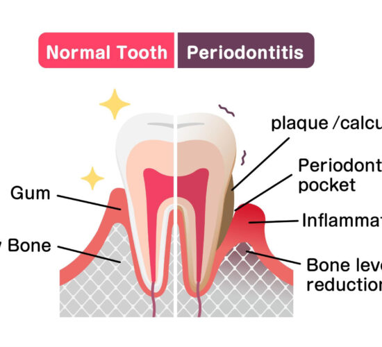 Parodontite: La Forme Avancée de la Gingivite