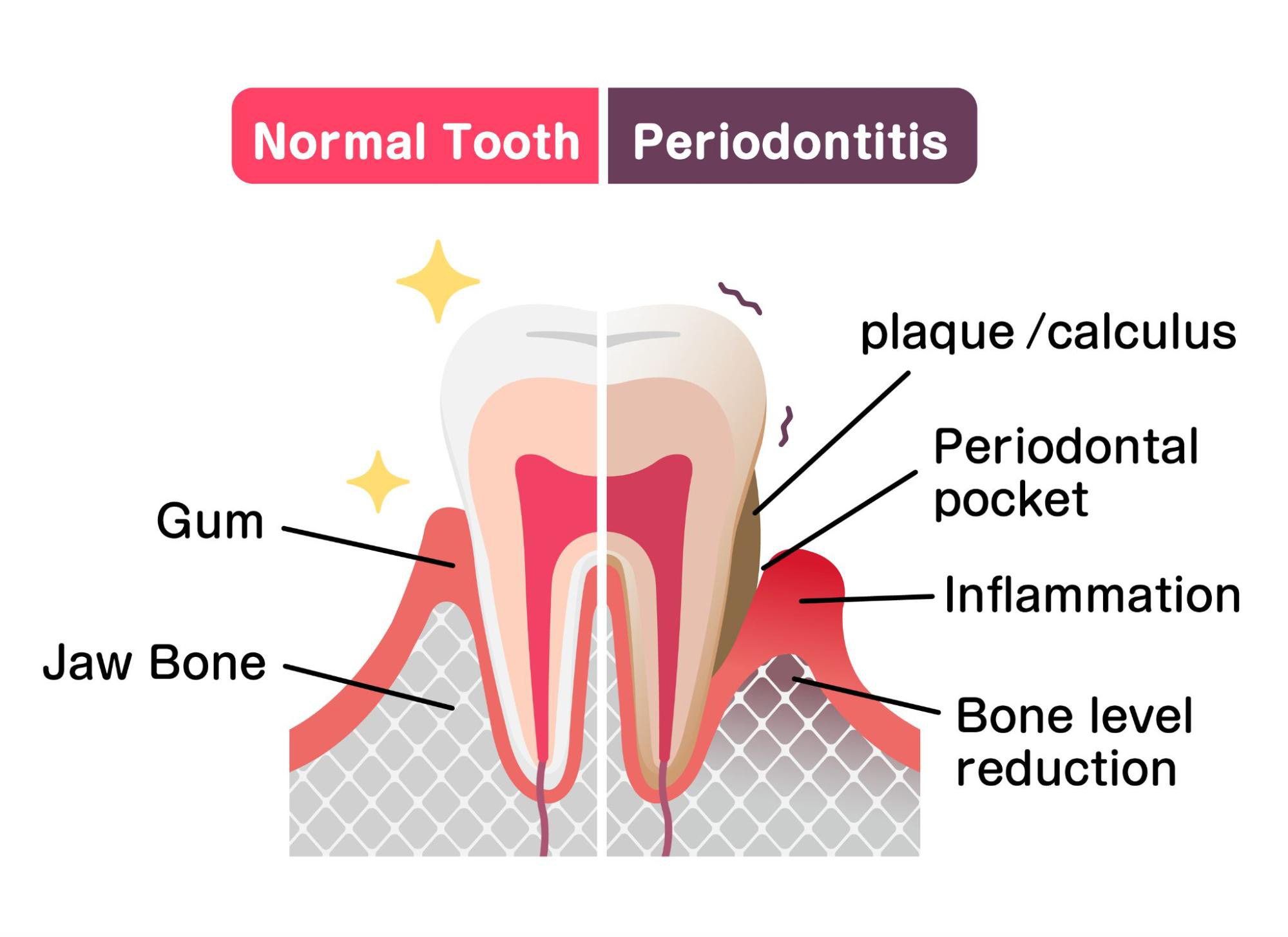 Periodontitis: The Advanced Form of Gingivitis