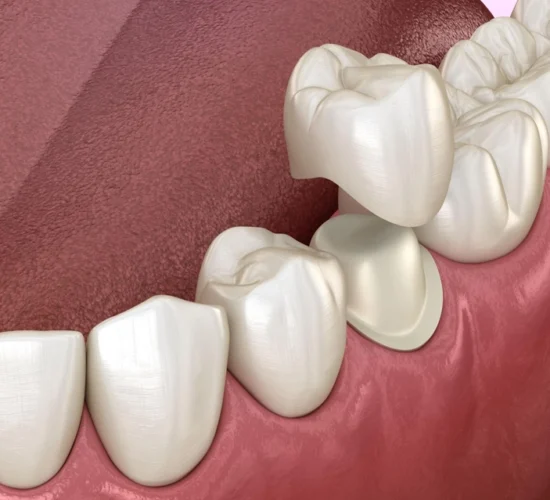 Couronnes le jour même avec CEREC