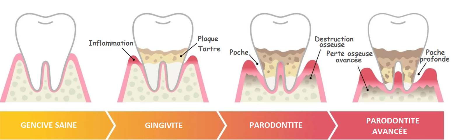 Stades de la Parodontite
