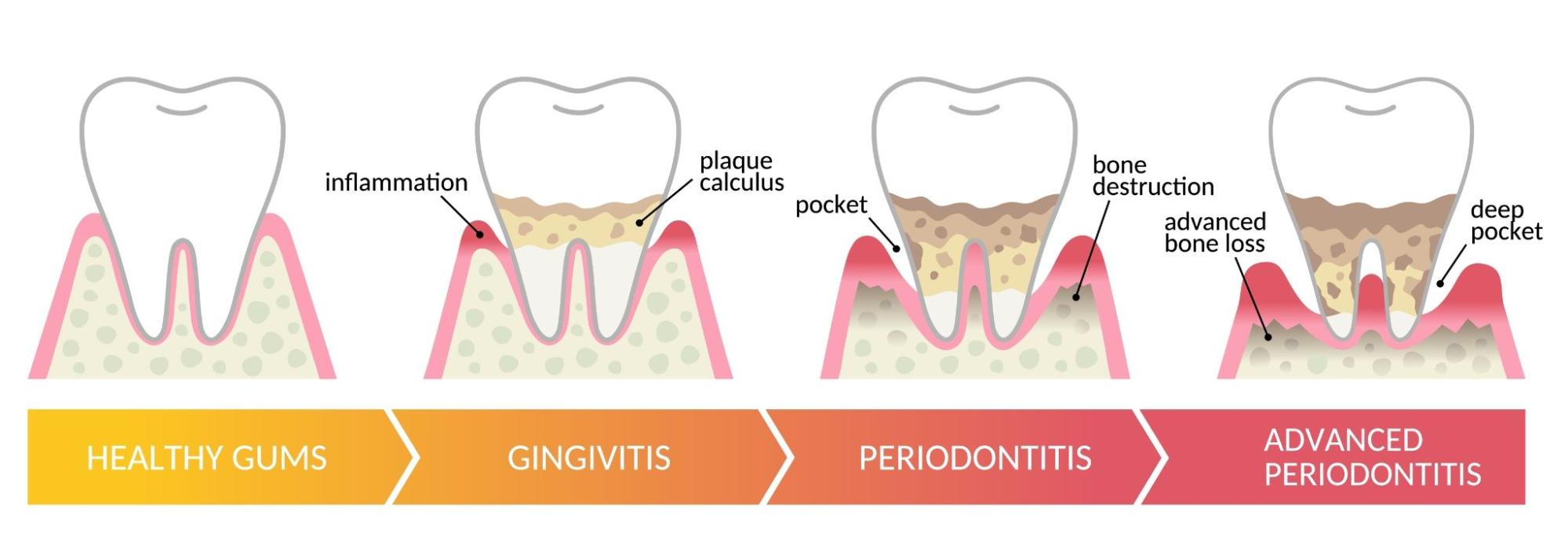 Stages of Periodontitis