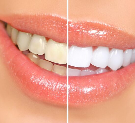 Un Guide Complet sur le Blanchiment Dentaire et la Décoloration