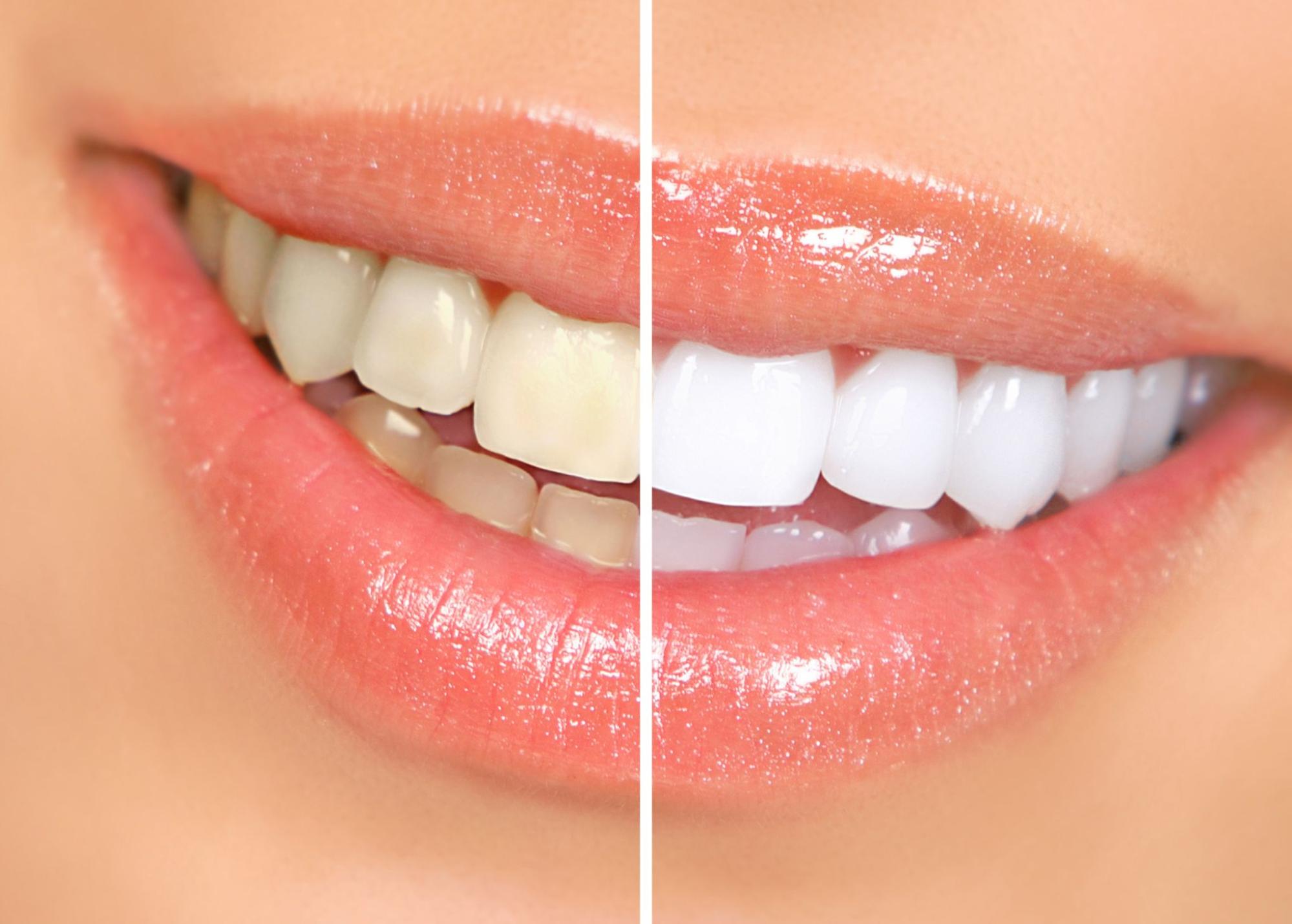 A Comprehensive Guide to Bleaching and Teeth Whitening