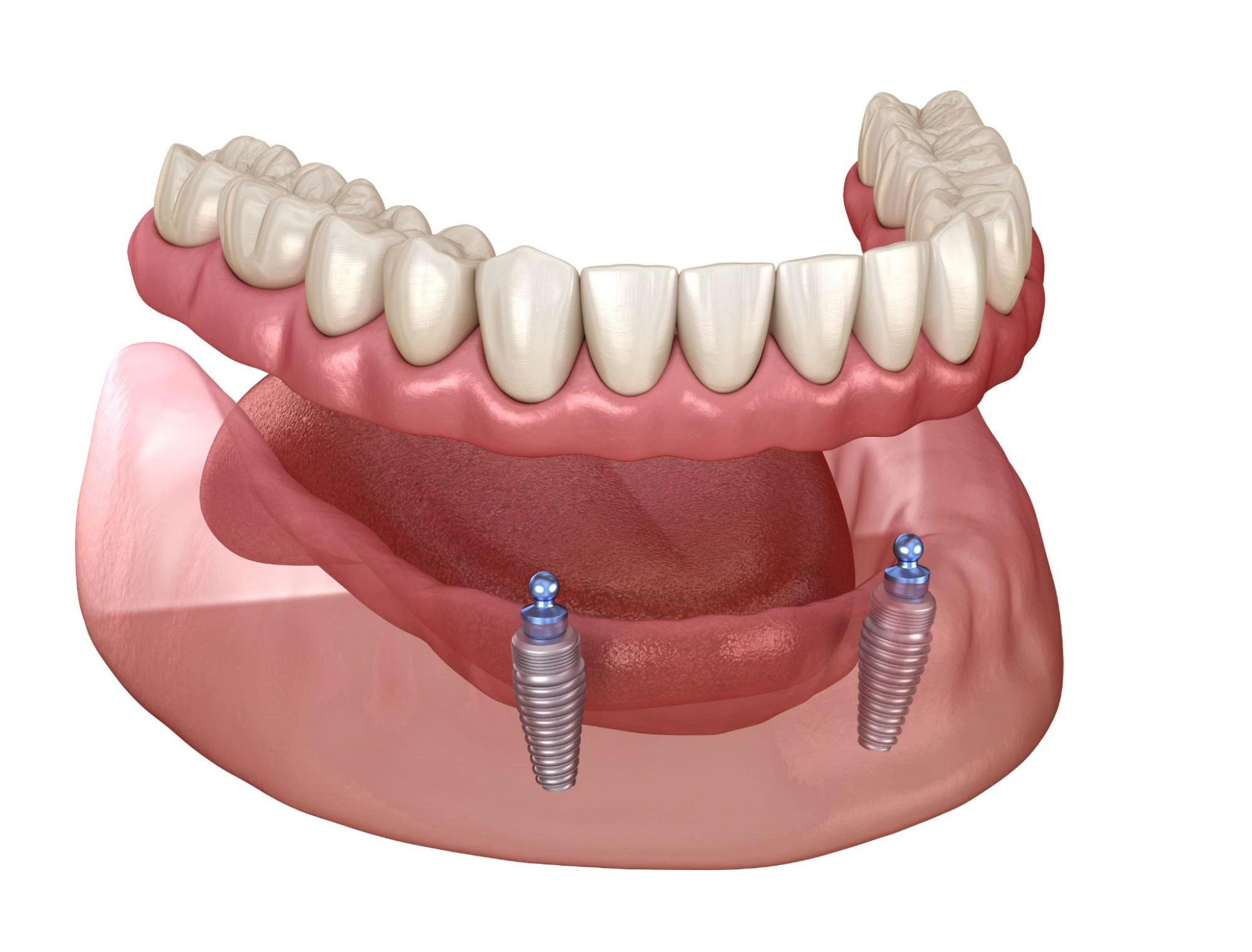 Lower snap-on dentures