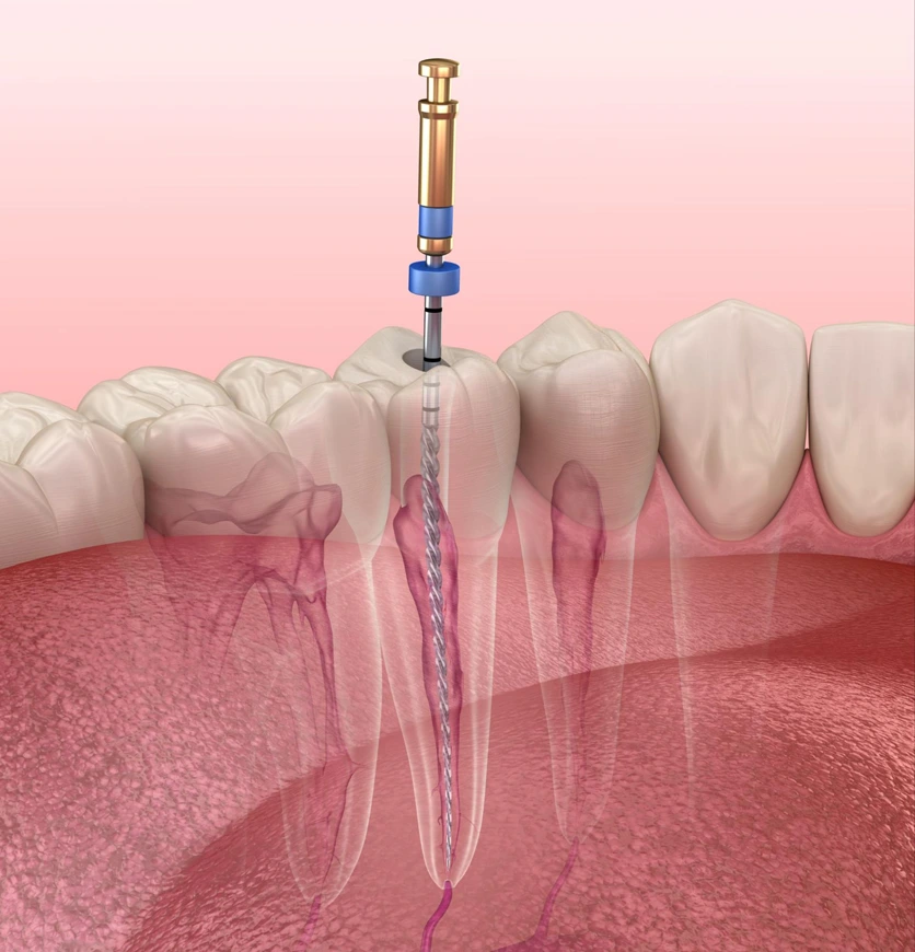 The removal of infected pulp from the root canal