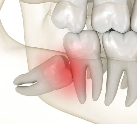 Guide complet sur l’extraction des dents de sagesse : indications, procédure, avantages et soins post-opératoires