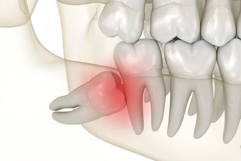 A Comprehensive Guide to Wisdom Tooth Removal: Indications, Procedure, Benefits, and Aftercare