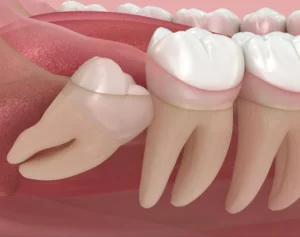 A partially impacted wisdom tooth tilted towards the second molar