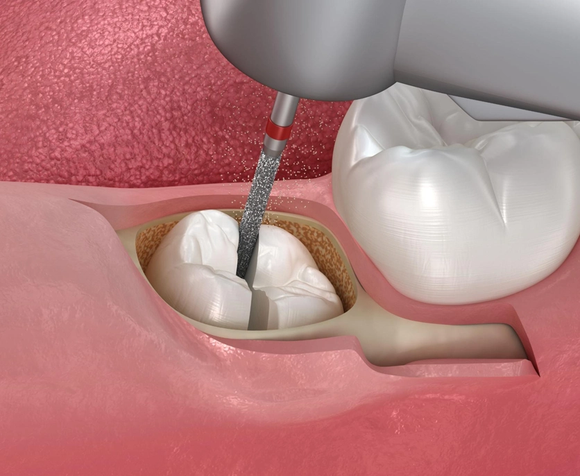 Sectioning an impacted tooth makes it easier to remove and minimizes damages to nearby teeth and soft tissues structures