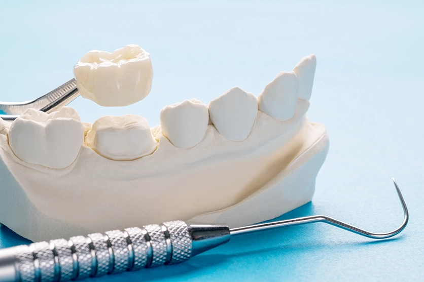 Canadian Dental Plan – RCSD – Frequently Asked Questions About Dental Crowns and Cast Partial Dentures