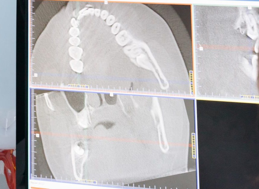 Which Montreal implant clinic can evaluate me after another dentist said I do not have enough jawbone for implants?