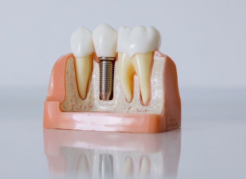 Where can I have an older dental implant evaluated in Montreal if I no longer see the dentist who placed it?